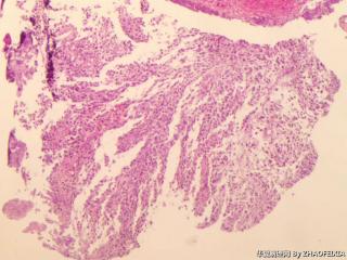 胃底包块活检组织图1