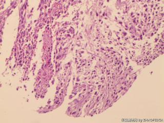 胃底包块活检组织图10