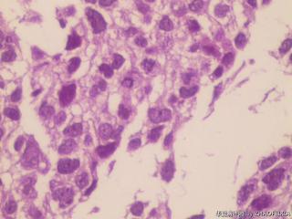 胃底包块活检组织图17