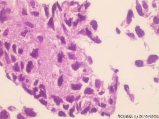 胃底包块活检组织图16
