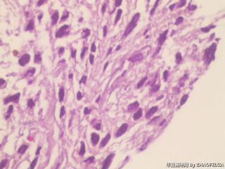 胃底包块活检组织图11