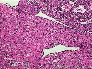 宫腔内组织图27