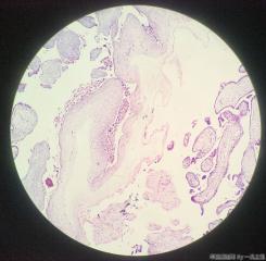 绒毛，够部分性葡萄胎？图16