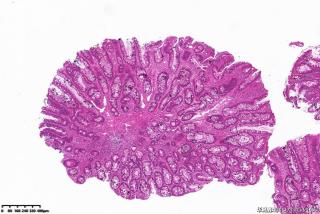 直肠息肉，管状绒毛状腺瘤，低级别？图4