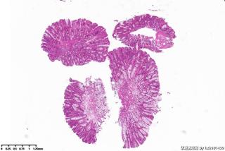 直肠息肉，管状绒毛状腺瘤，低级别？图1