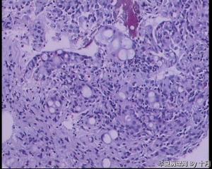 胃窦溃疡活检组织图23