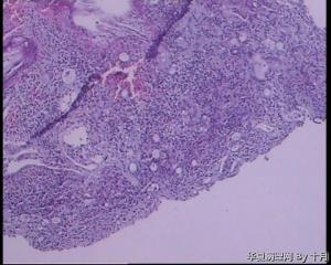 胃窦溃疡活检组织图24