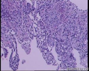 胃窦溃疡活检组织图20