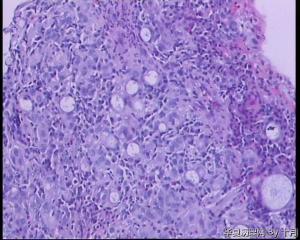 胃窦溃疡活检组织图11