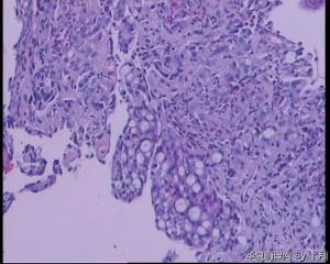 胃窦溃疡活检组织图13