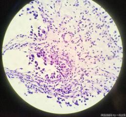 膀胱新生物活检图6