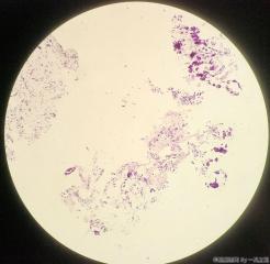 膀胱新生物活检图16