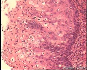 请老师看看宫颈息肉被覆上皮CIN II累腺吗？图4