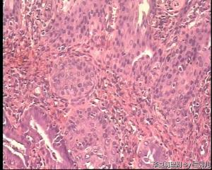 请老师看看宫颈息肉被覆上皮CIN II累腺吗？图6