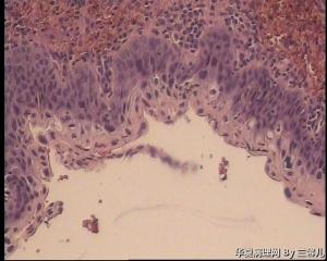 请老师看看宫颈息肉被覆上皮CIN II累腺吗？图14