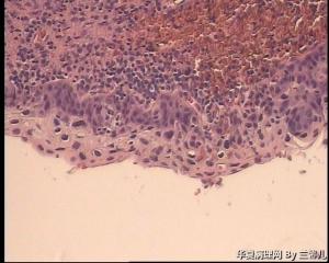 请老师看看宫颈息肉被覆上皮CIN II累腺吗？图12