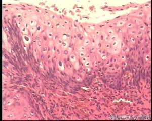 请老师看看宫颈息肉被覆上皮CIN II累腺吗？图3