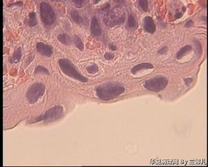 请老师看看宫颈息肉被覆上皮CIN II累腺吗？图10