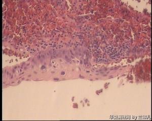 请老师看看宫颈息肉被覆上皮CIN II累腺吗？图7