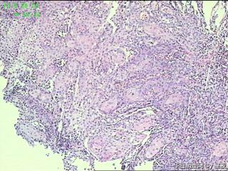 食管活检组织，高分化鳞癌？请教！图2