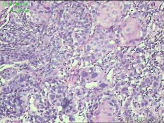 食管活检组织，高分化鳞癌？请教！图8