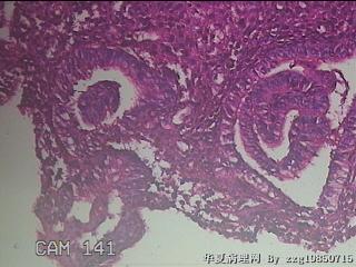 宫腔内组织图37