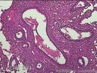 宫腔内组织图34