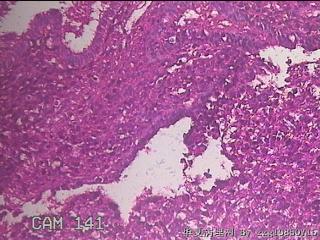 宫腔内组织图40