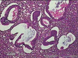 宫腔内组织图37