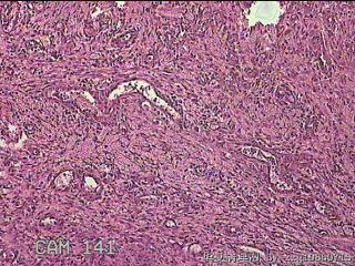 宫腔粘膜赘生物图15