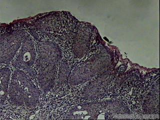 宫颈内口赘生物，请教是鳞化还是上皮内瘤变？图7