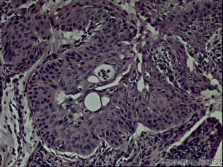 宫颈内口赘生物，请教是鳞化还是上皮内瘤变？图11