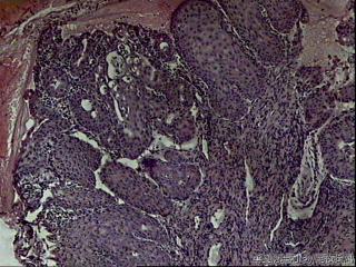 宫颈内口赘生物，请教是鳞化还是上皮内瘤变？图5
