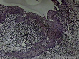 宫颈内口赘生物，请教是鳞化还是上皮内瘤变？图4
