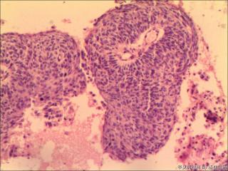 女 ，宫颈锥切组织，表面菜花状图1