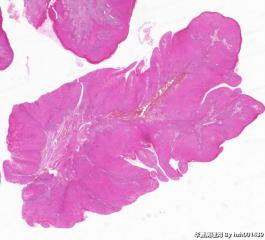 外阴赘生物，尖锐湿疣？图12