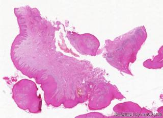 外阴赘生物，尖锐湿疣？图16