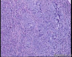 食管隆起肿物活检组织图16