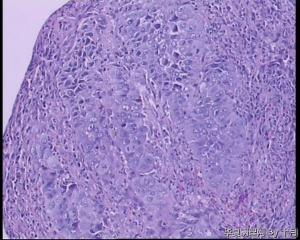 食管隆起肿物活检组织图10