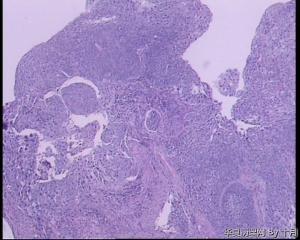 食管隆起肿物活检组织图13