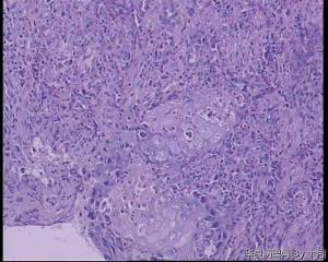 食管隆起肿物活检组织图20
