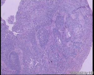 食管隆起肿物活检组织图12