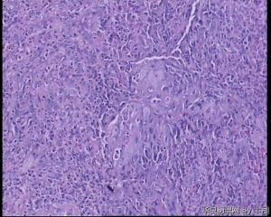 食管隆起肿物活检组织图17