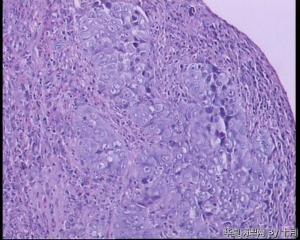 食管隆起肿物活检组织图19