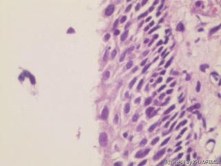 宫颈活检组织图14
