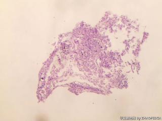 宫颈活检组织图1