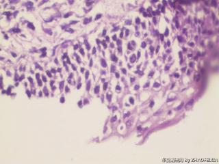 宫颈活检组织图19