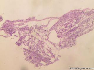 宫颈活检组织图2