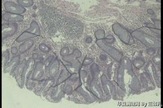 乙状结肠息肉，腺瘤性息肉还是增生性息肉？图3