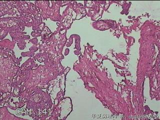 宫腔組织图33